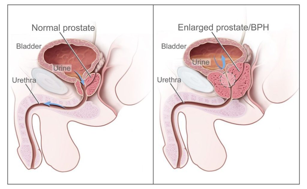 how-to-prevent-prostate-cancer-naturally_1.jpg