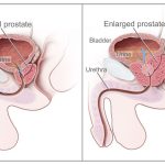 how-to-prevent-prostate-cancer-naturally_1.jpg