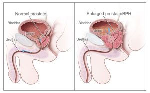 how-to-prevent-prostate-cancer-naturally_1.jpg