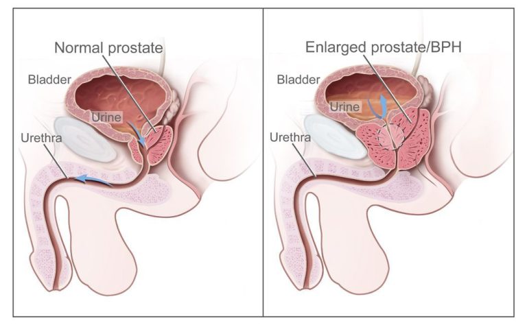 how-to-prevent-prostate-cancer-naturally_1.jpg